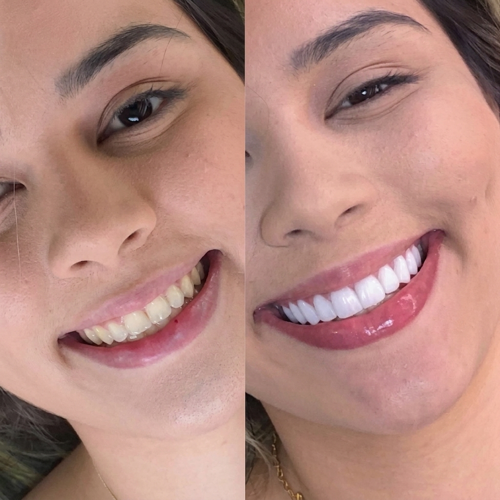 Caso real de blanqueamiento dental — antes y después