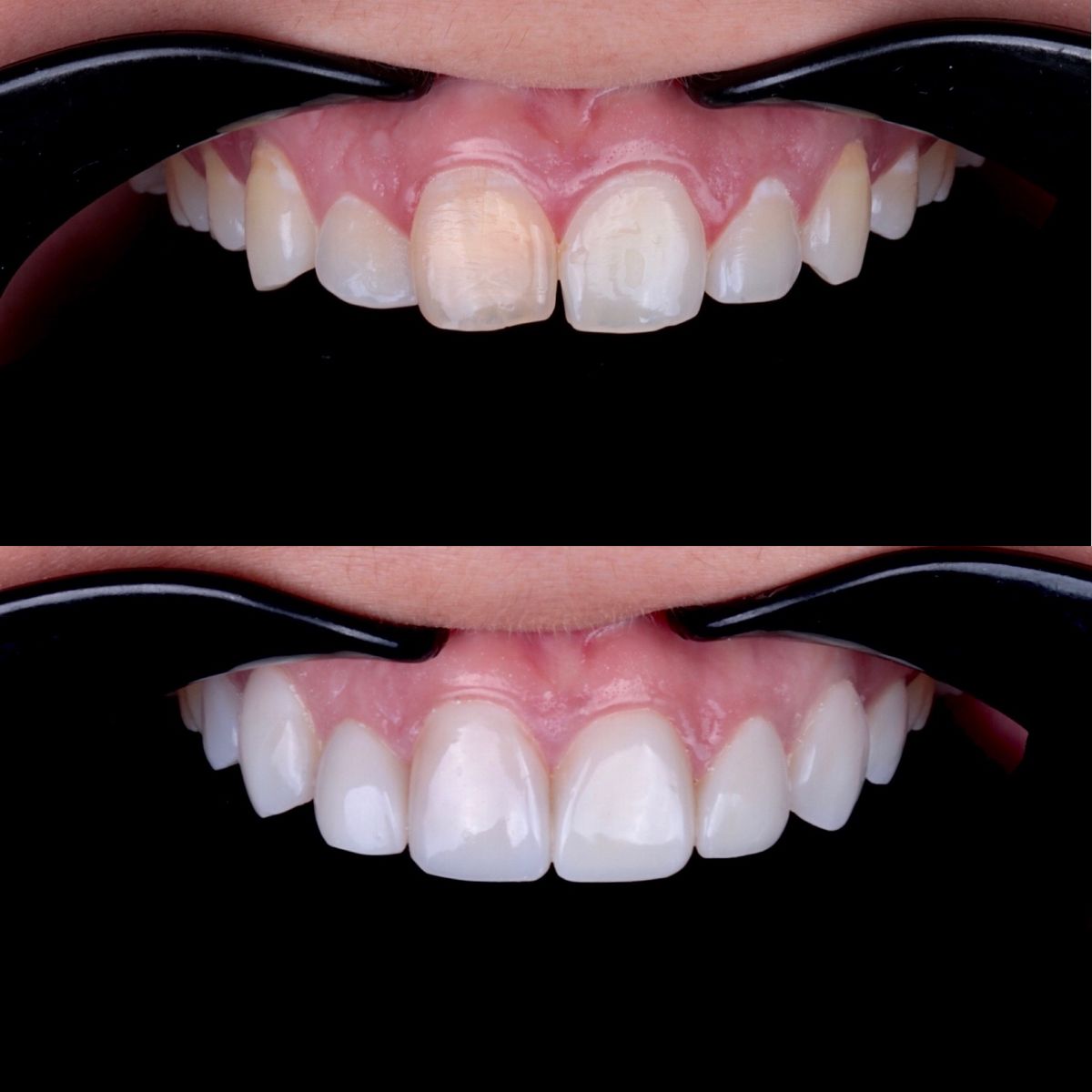 Caso real de diseño de sonrisa — antes y después con carillas